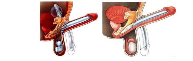 Prothese zur Penisvergrößerung